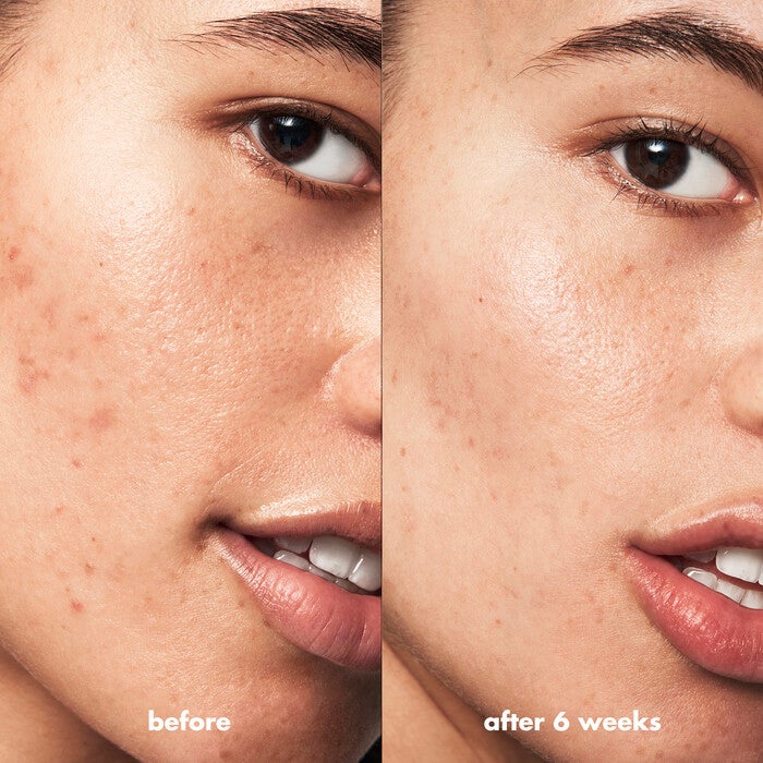 Blemish Breakthrough Control Basics Kit, 