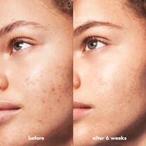 Blemish Breakthrough Control Basics Kit, 
