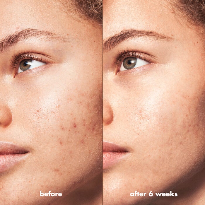 Blemish Breakthrough Control Basics Kit, 